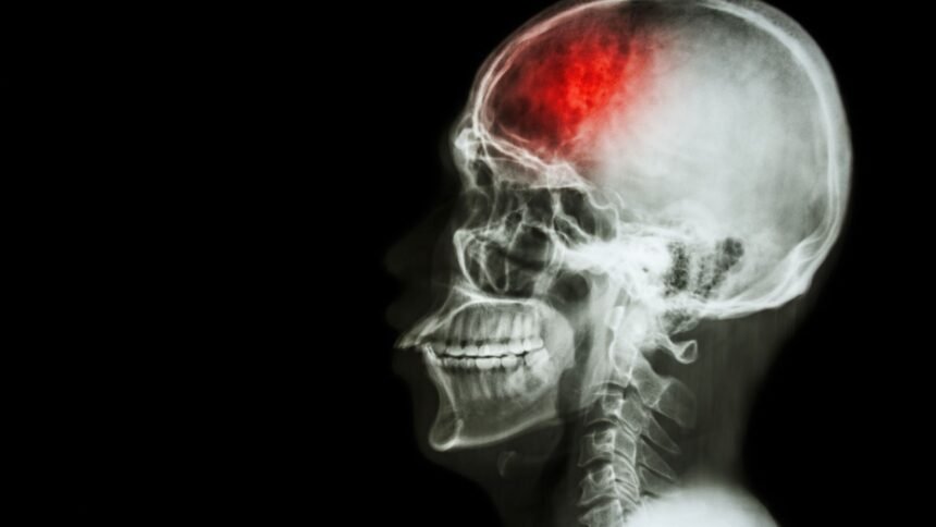 stroke