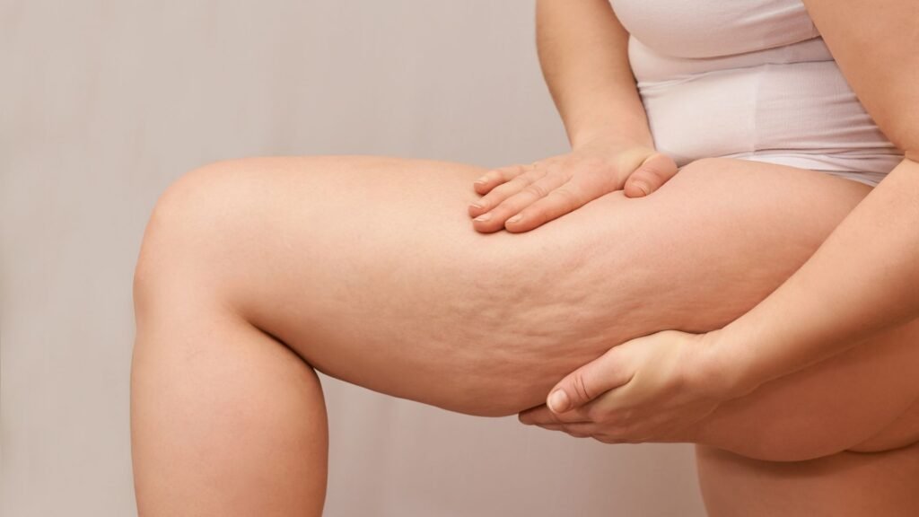 cellulite